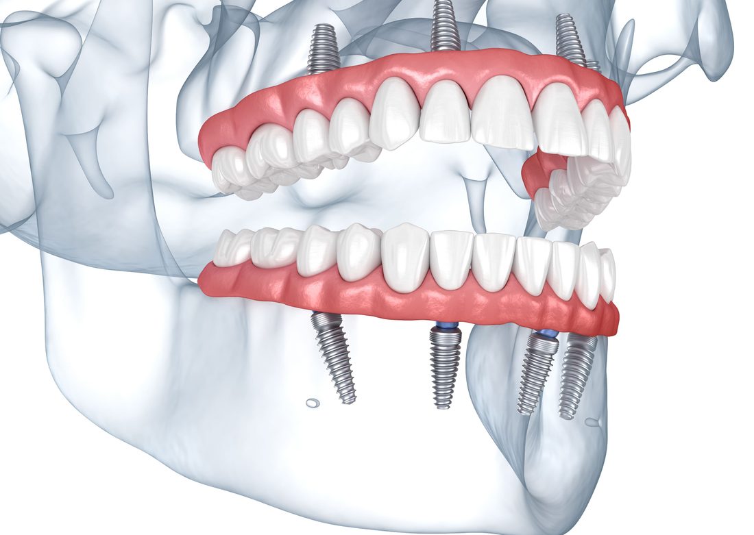 All-On-4 Implants