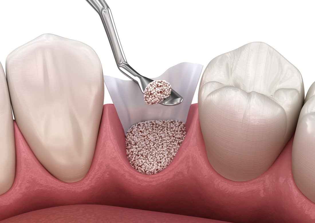Bone Grafting