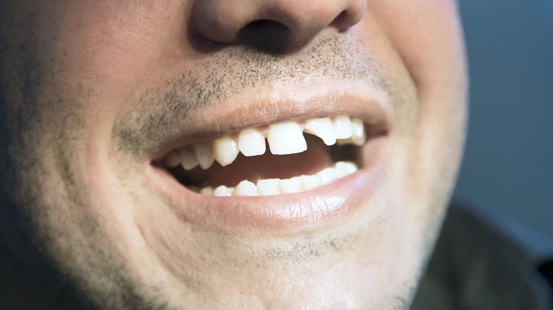 Broken or Chipped Teeth