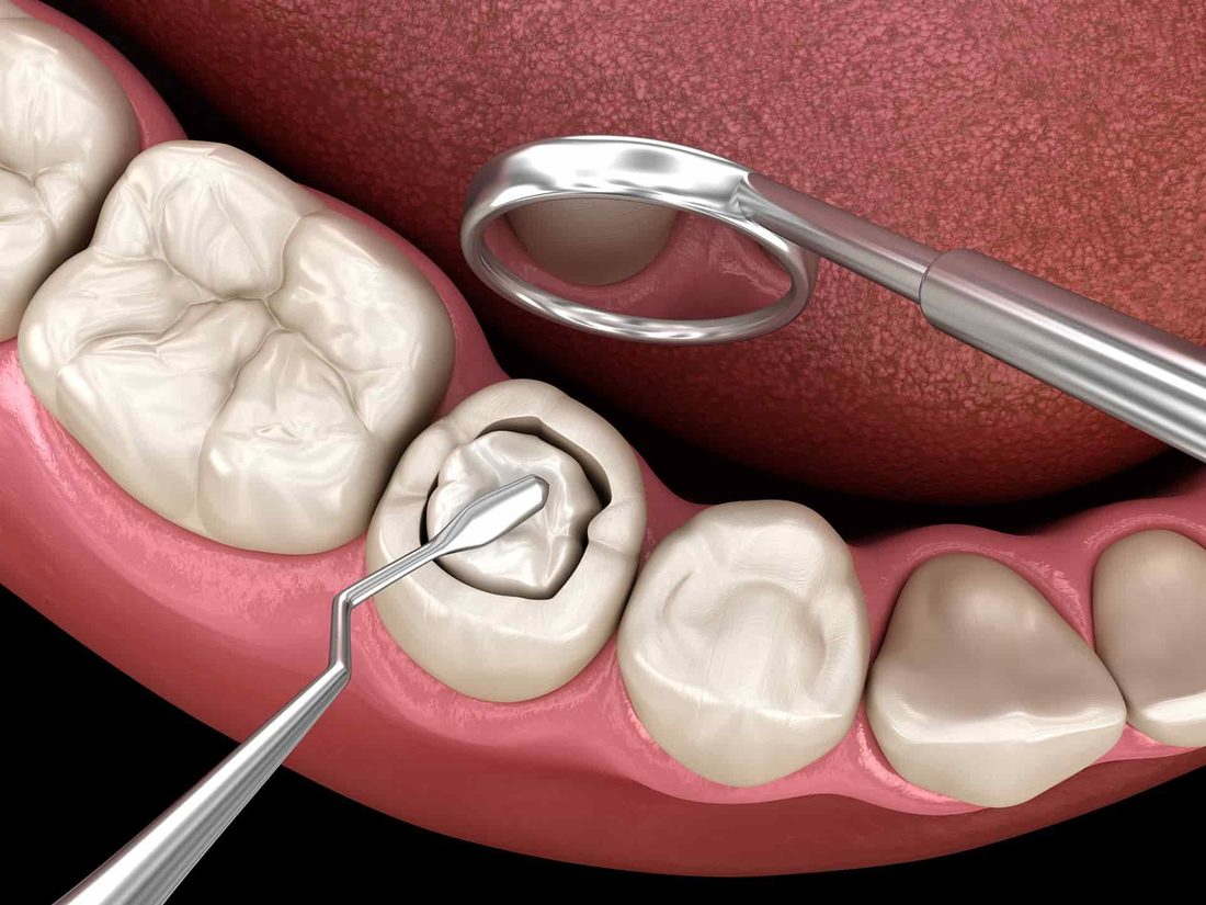 Composite Filling (BPA-Free)