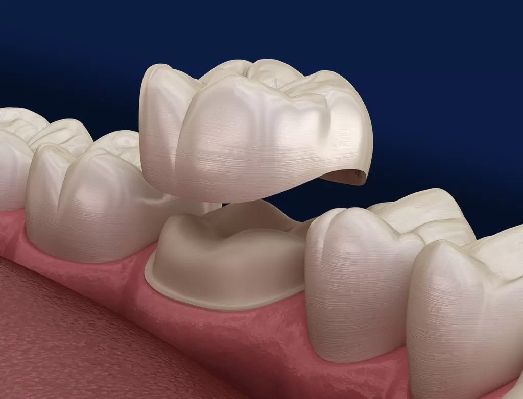 Dental Crowns