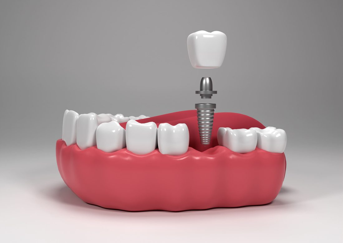 Dental Implants