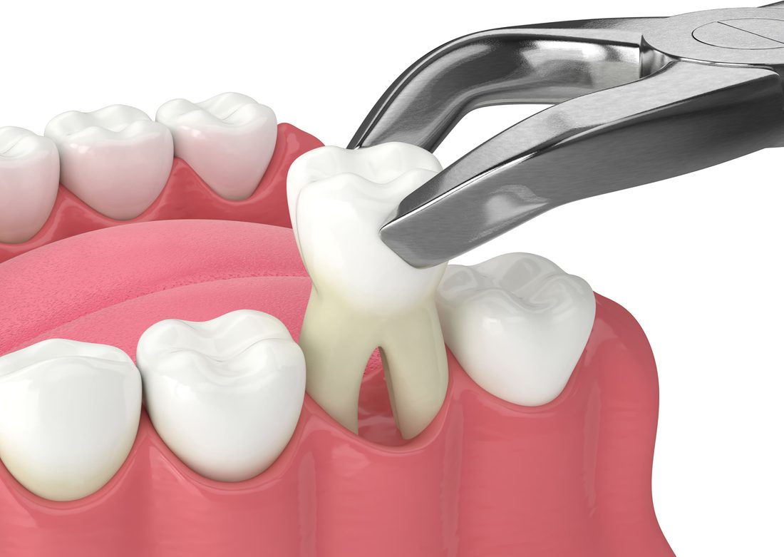 Extractions