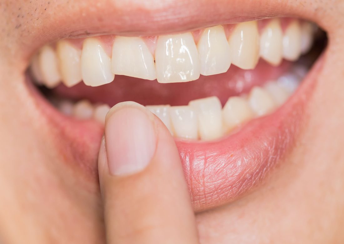 Fractured Tooth Treatment