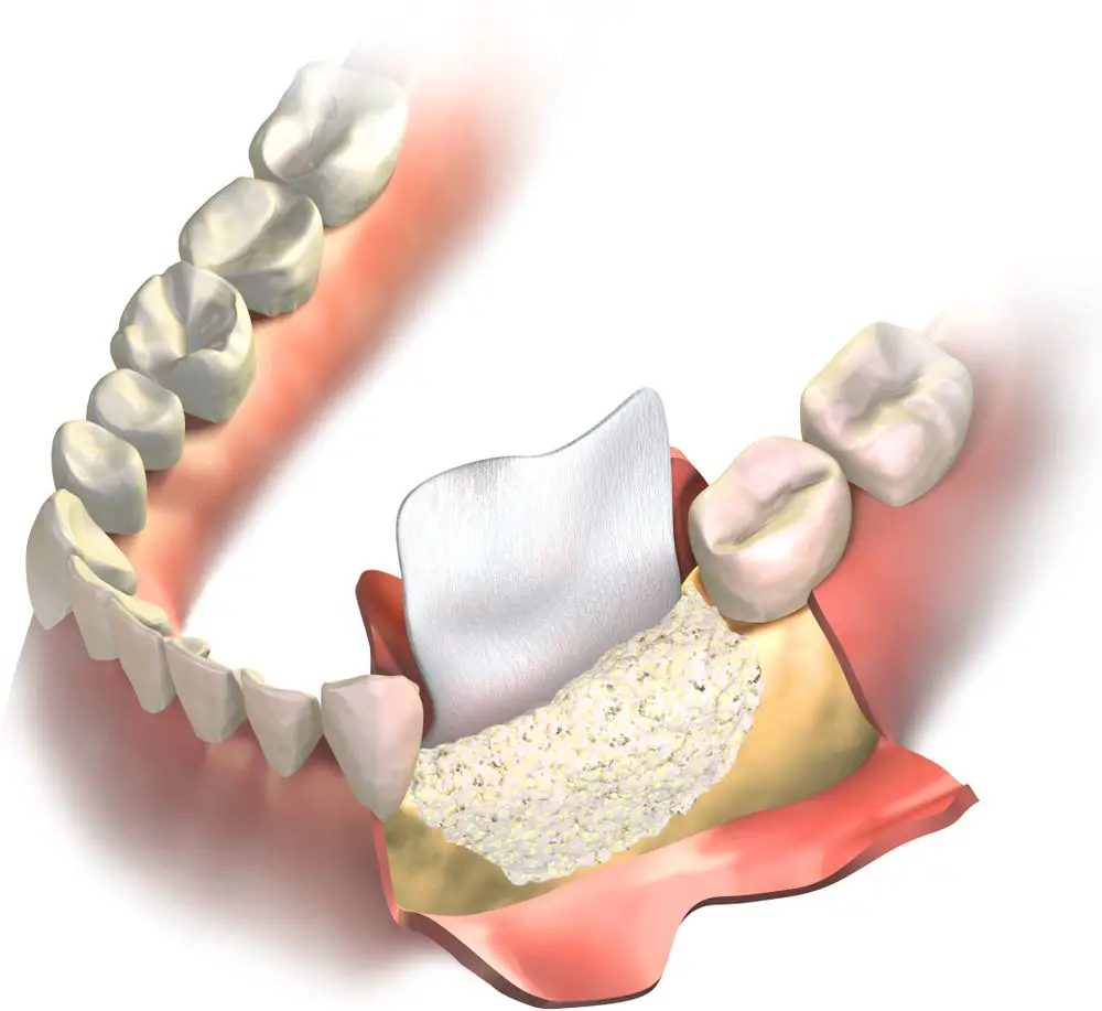 Guided Bone Regeneration