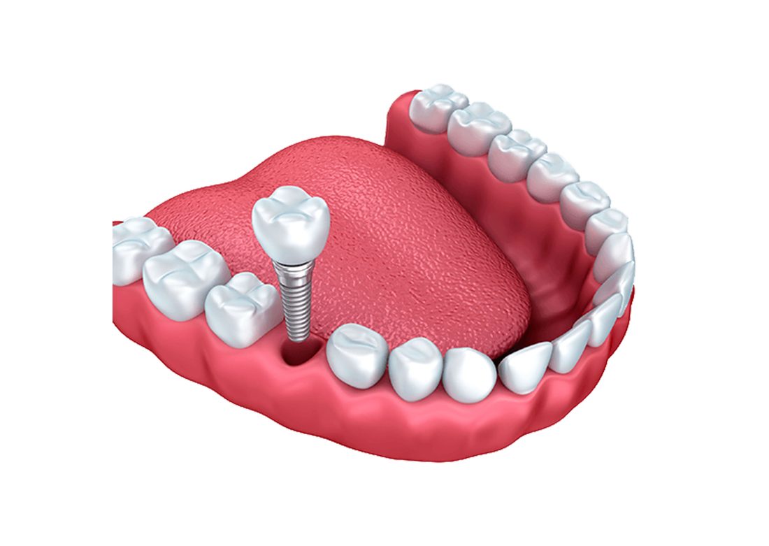 Guided Dental Implant Surgery
