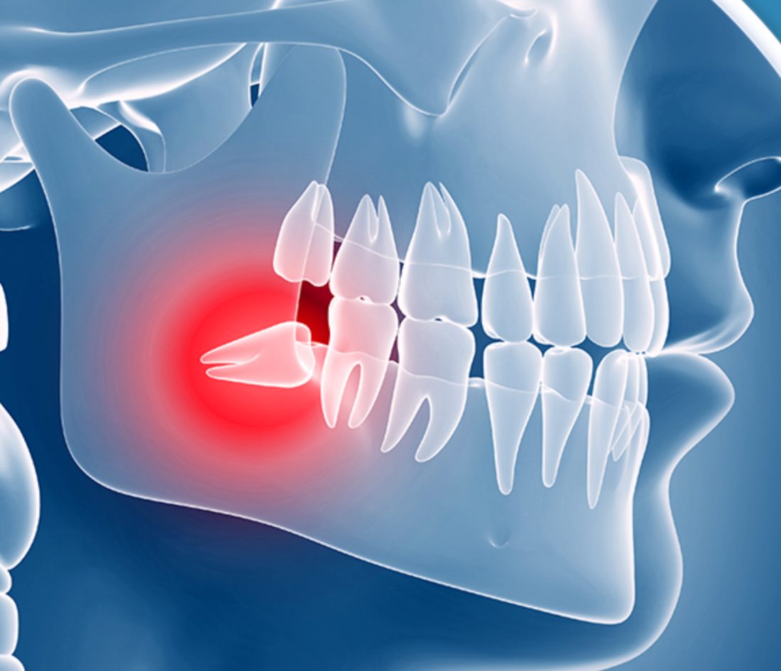 Impacted Wisdom Tooth Removal