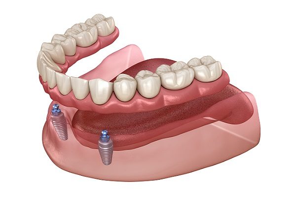 Locator or Bar Attachment Dentures