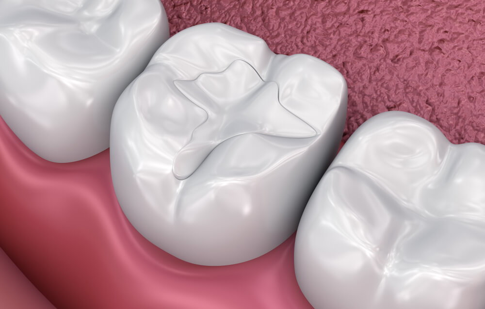 Lost or Loose Fillings