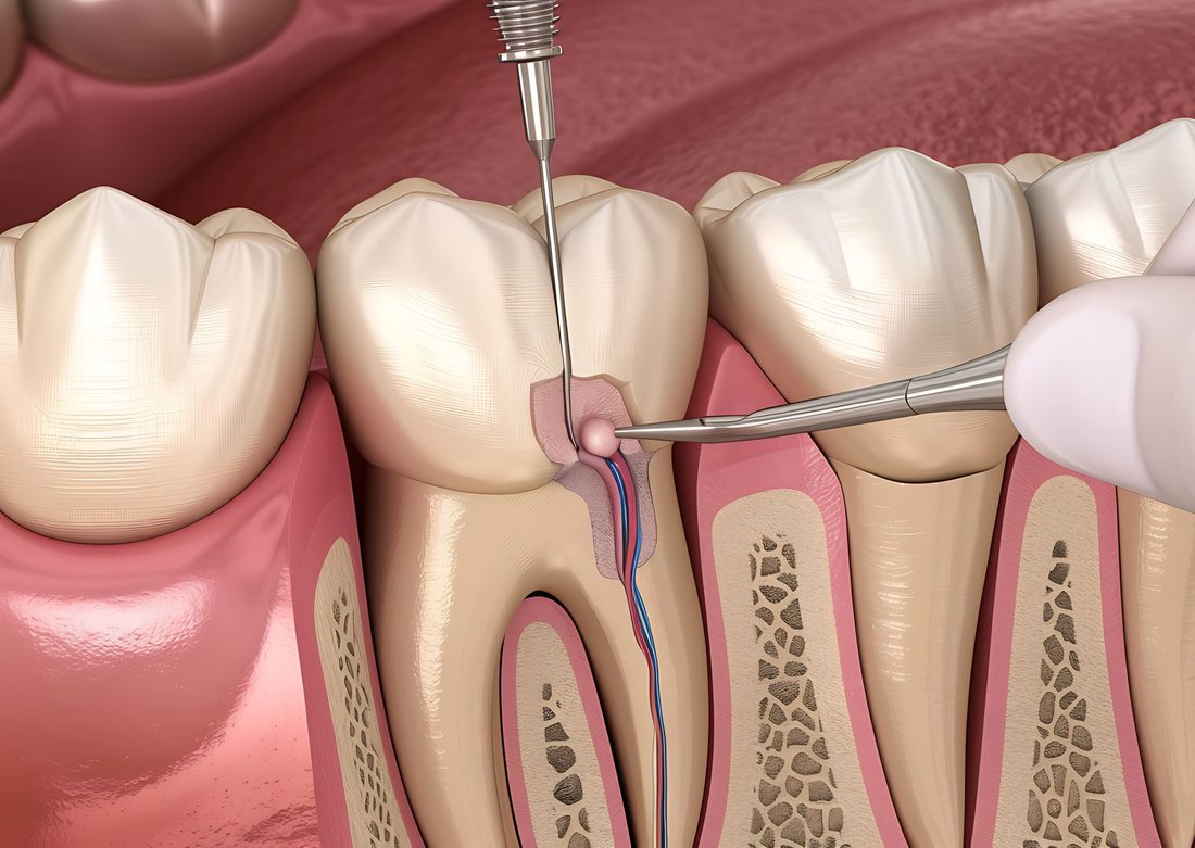 Root Canal Treatment