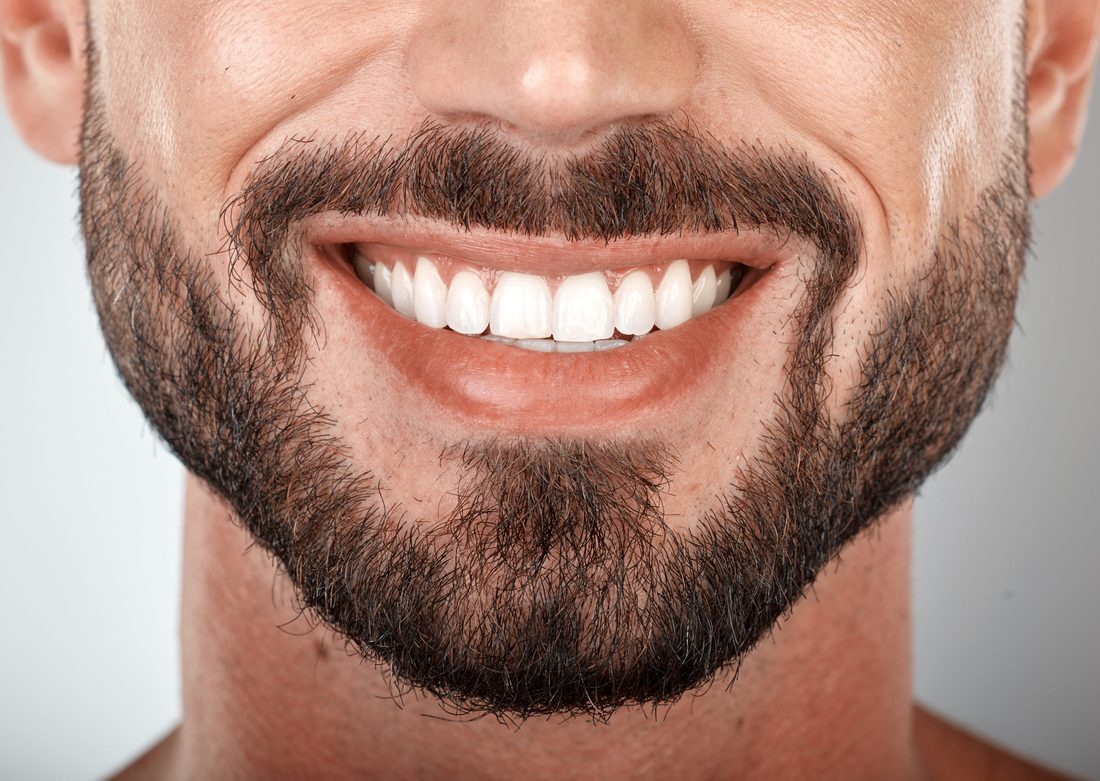 Veneers